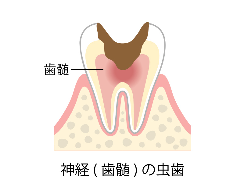 C3 神経・歯髄の虫歯
